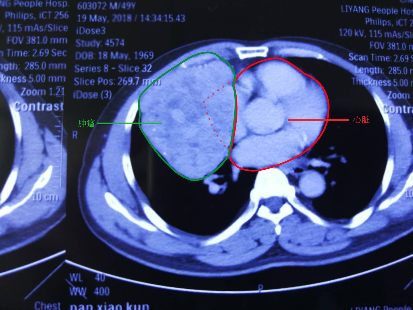 胸壁肿瘤的CT诊断 - 知乎